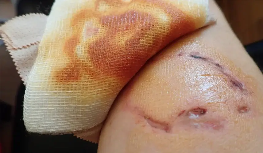 A big wound from a dog bite.